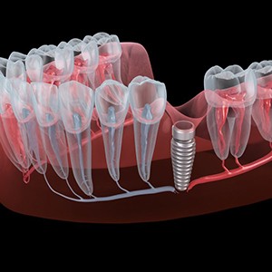 Illustration of dental implant in gum tissue