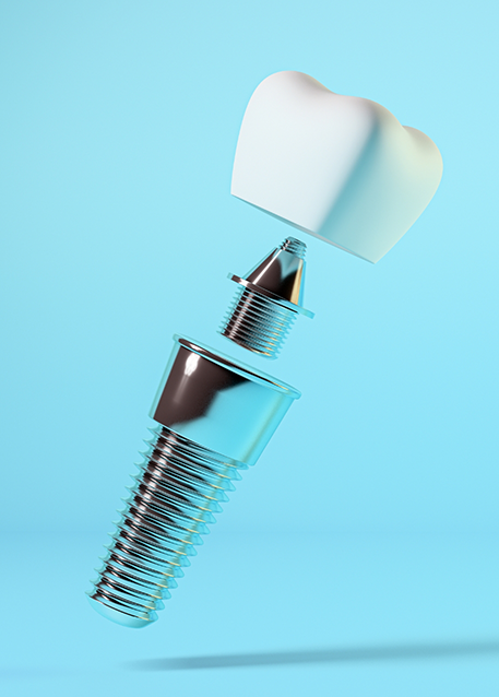 Model of a dental implant post, a dental crown, and a metal abutment connector piece