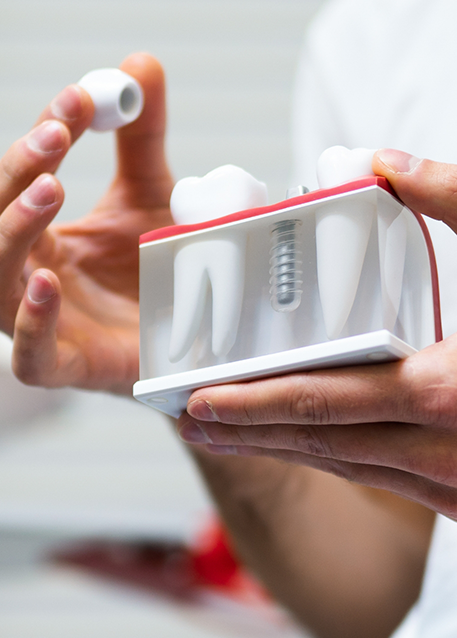 Dentist holding a model of a dental implant in the jaw