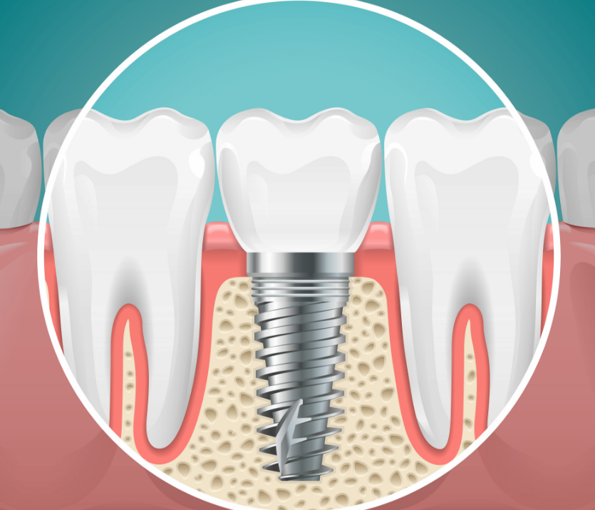 Illustrated cross section of a dental implant